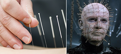 dry_needling_pinhead